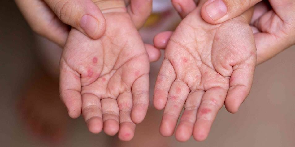 Denuncian brote de virus Coxsackie en comunidad de Tankuché