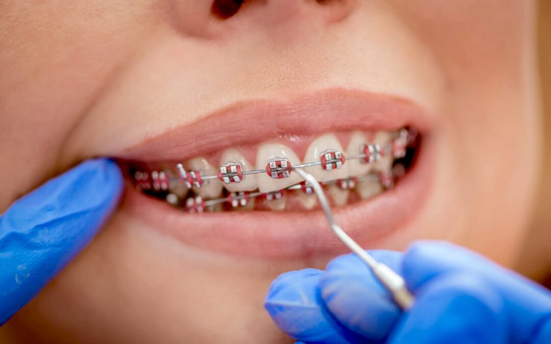 Son brackets, la mejor solución para una sonrisa saludable